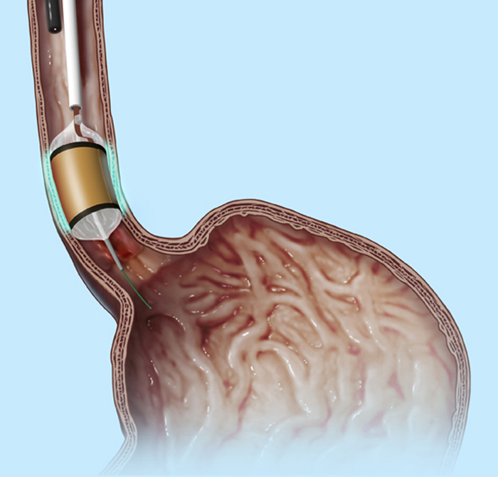 Radiofrequency ablation medical illustration