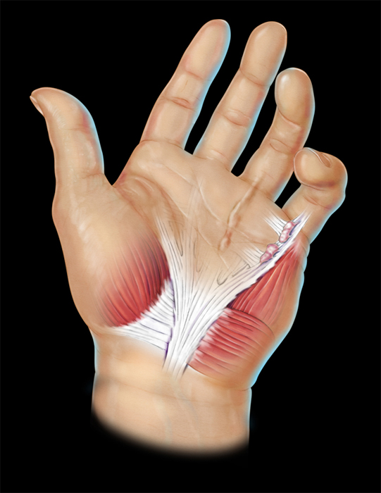 Dupuytren's contracture medical illustration