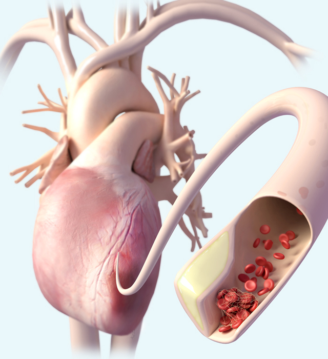 Heart attack medical illustration