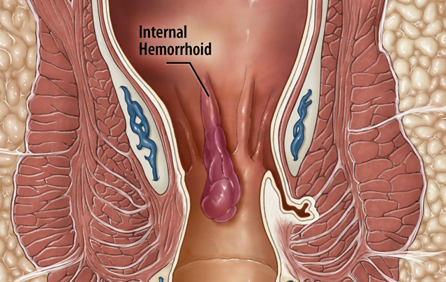 Hemorrhoids - Clark Medical Media