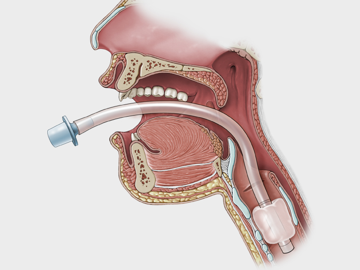 Intubation medical illustration