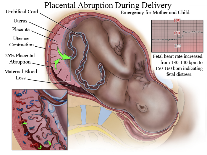 Placental abruption medical illustration