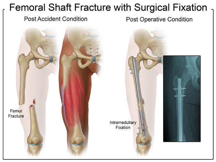 Intramedullary fixation rod medical illustration