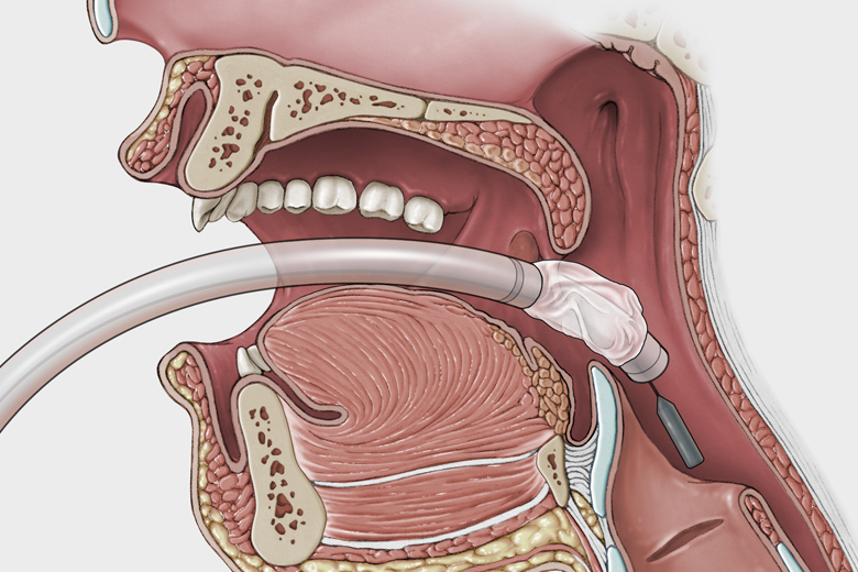 GaTech intubation illustration