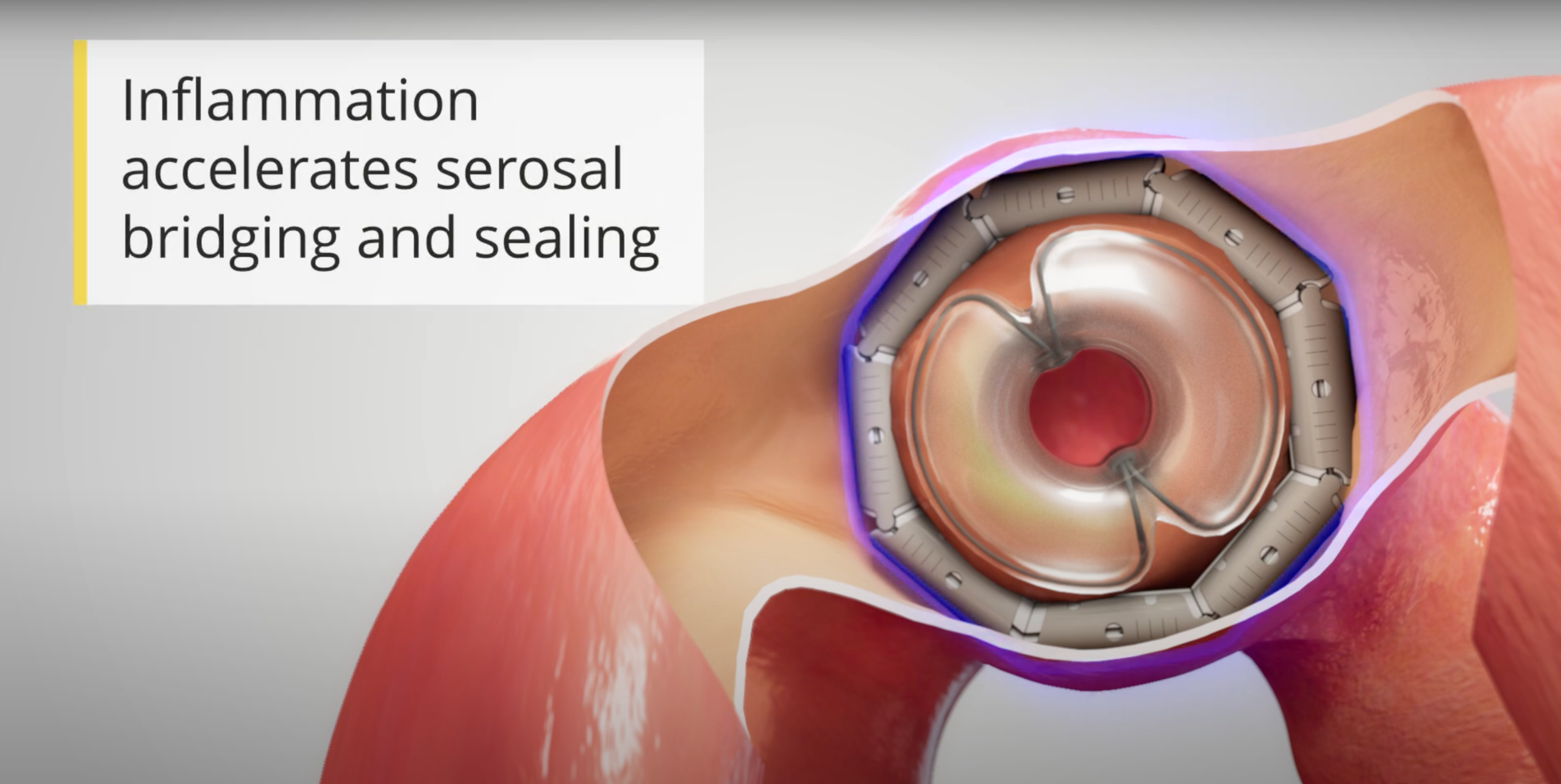 Cutaway in GI animation